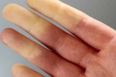 «Likfingre»: - Verdt en prat med legen hvis du opplever dette