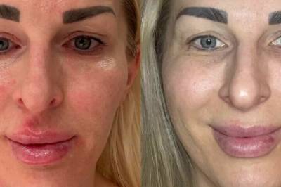 Da Mettes hud gikk fra tørr til hoven og rød, forsto hun endelig hva som var årsaken