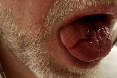 Beit av mannens tunge: - Jævla slitsom