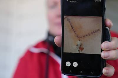 Operert av kirurg som granskes: – Jeg trodde jeg skulle stryke med