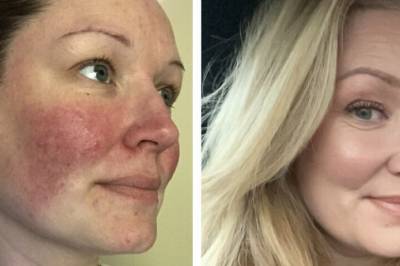 Margrethe slet med kraftig rosacea i årevis. Så fant hun løsningen