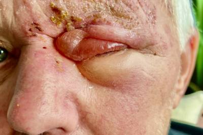 Bjørn (71) fikk «helvetesviruset» - advarer