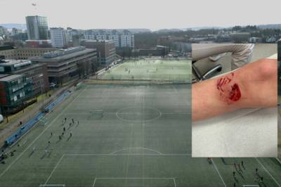 11-åring skambitt på fotballtrening – hundeeieren stakk av