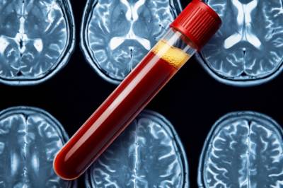 1 av 10 eldre kvalifiserer til Alzheimers-behandling, viser norsk studie som er først i verden