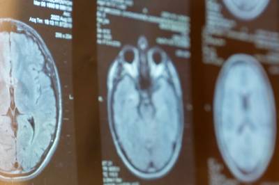 Immunterapi mot MS: Ingen forskjell mellom den billige og den dyre varianten