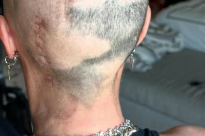 Våknet med livstruende utslett