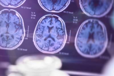 Stor studie av nye alzheimer-medisiner: Gir ingen menings­full effekt