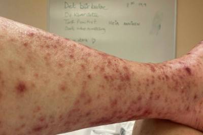 Startet som halsbetennelse: - Et smertehelvete