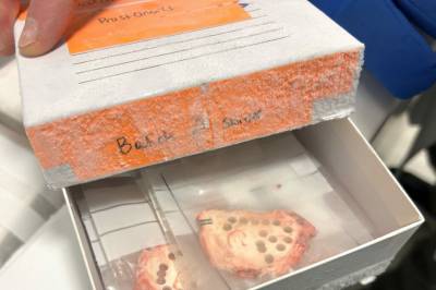 Slik avslørte forskerne aggressiv prostatakreft