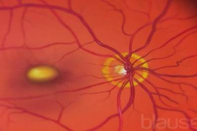 Trombolyse ved akutt sentral retinalarterie okklusjon?