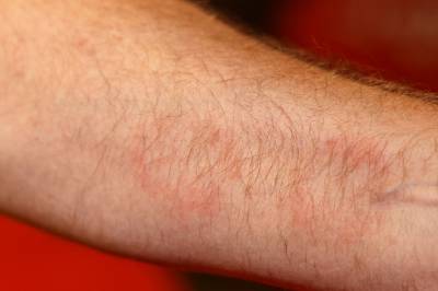 Over 2500 fikk veggedyr i fjor: – Kan koste mer enn ferien