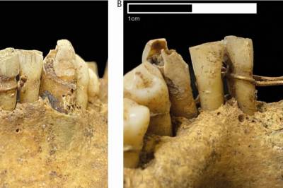 Arkeologer kan ha funnet 500 år gammel tannregulering