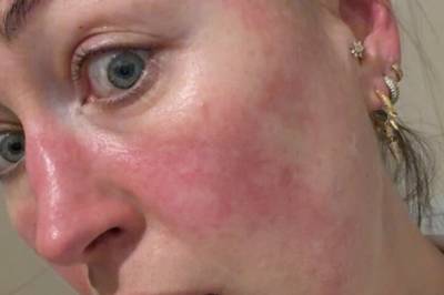 Stines rosacea ble verre med årene. Et enkelt råd fra fastlegen skulle bli redningen