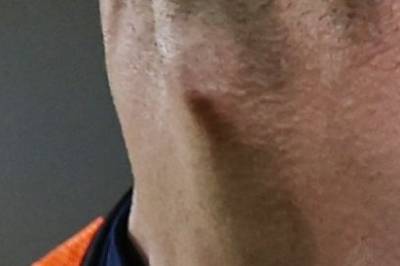 Hva kalles dette «eplet» som er mest synlig hos menn?