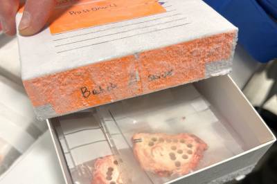 Avslørte aggressiv prostatakreft med banebrytende metoder