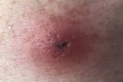 Har du hørt om myiasis?
