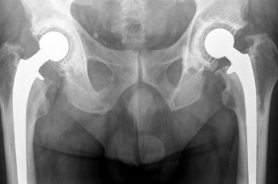 Hvor lenge holder en hofteprotese?