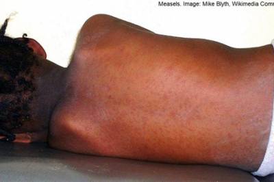 Meslingestatus i Europa