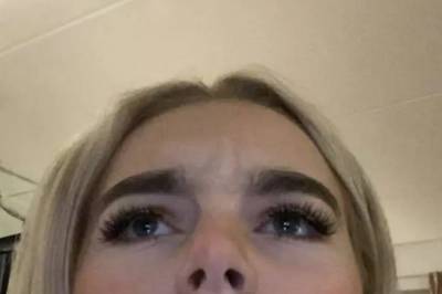 Advarer mot leppe­fillers: – Jeg visste ikke hva jeg gikk til