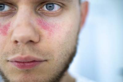 Er det kyssesykeviruset som står bak lupus?