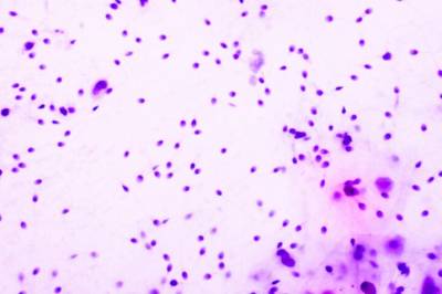 Kreftalarm: 200 barn rammet