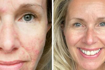 Hver gang Pia gikk til hudlege, fikk hun enten ny diagnose eller ny krem. Så prøvde hun noe helt nytt