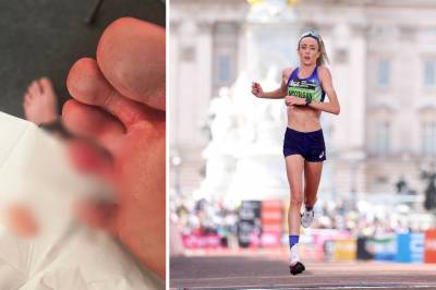 Sprang maraton med «open tå»: – Kjentest ut som foten eksploderte
