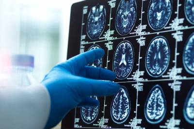 Han er verdensledende innen Alzheimers-forskning: – Tre råd for å hindre sykdommen