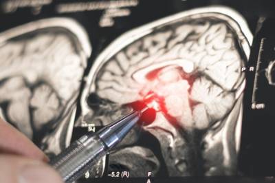 Elektrisitet i hjernen hjalp mot tics ved Tourettes