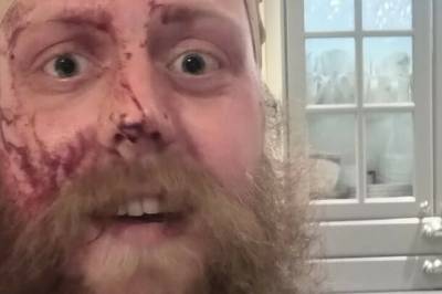 Angrepet med balltre etter trafikkhendelse: - Synd