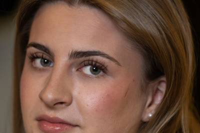 Rebecca (22) fikk tabubelagt hudsykdom: – Følte meg veldig ekkel