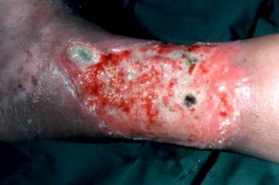 Hva er risikoen for posttrombotisk syndrom etter en dyp venetrombose?