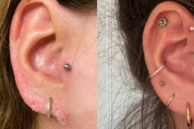 Etter å ha prøvd alt, fant Emilie en effektiv kur mot psoriasis