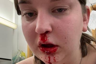 Stopper livreddende tilbud: Ida (21) kunne vært død uten