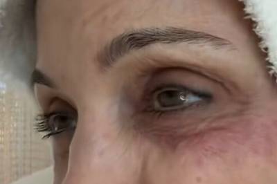 - Allergisk mot St. Barths