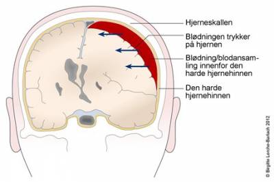 Embolisering av arterie ved kronisk subduralt hematom