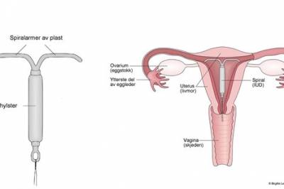 Intrauterin lokalbedøvelse ved innsetting av spiral