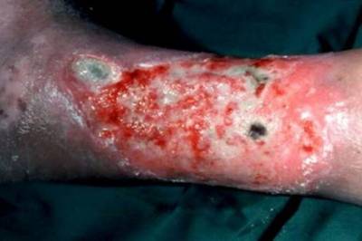 Endovaskulær behandling av posttrombotisk syndrom