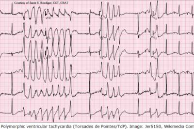 Bør kaliumnivået økes hos pasienter med høy risiko for ventrikulære arytmier?
