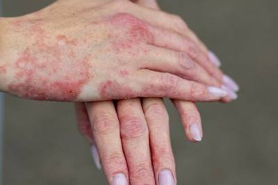 Nye psoriasis-funn: - Signifikant bedring av huden