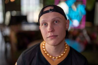 Mistet håret på hele kroppen: – Påvirket hele min identitet