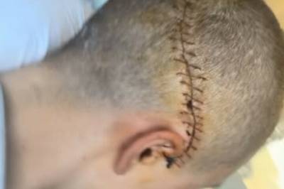 Tilbake i Norge etter stygg ulykke