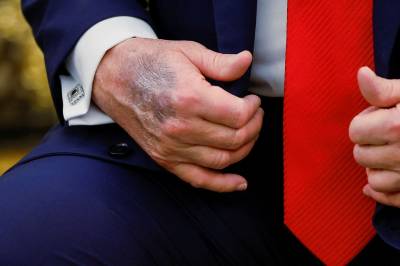 Et middel Trump har tatt i årevis mot hårtap, er forsvunnet fra medisinlisten hans