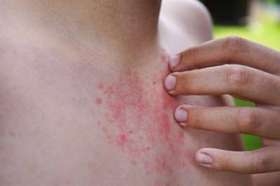 Kan en enkelt dose lokalbehandling kurere skabb?