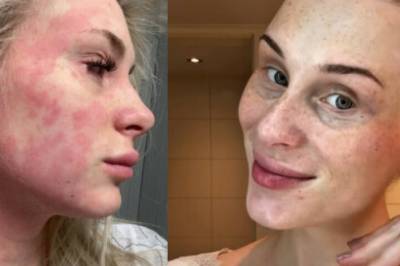 Sunniva har slitt med atopisk eksem hele livet. Bestemors råd til 199 kroner ble redningen