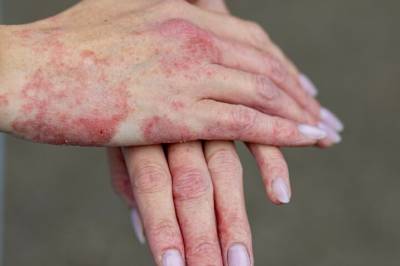 Ny psoriasis-studie: 71 prosent bedring for denne gruppen