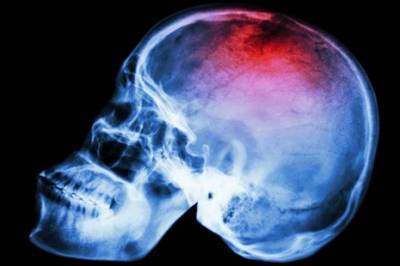 Tenekteplase gitt 4,5 til 24 timer etter akutt iskemisk slag