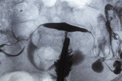 Hormoner mot overgangsalder? Det fins et oversett alternativ