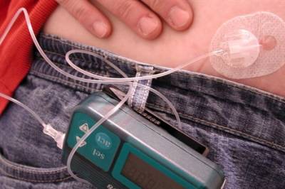Automatisk insulindosering til gravide med type 1-diabetes
