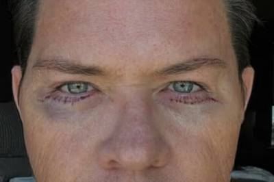 Avslører: La seg under kniven